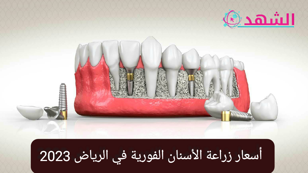 أسعار زراعة الأسنان الفورية في الرياض 2023