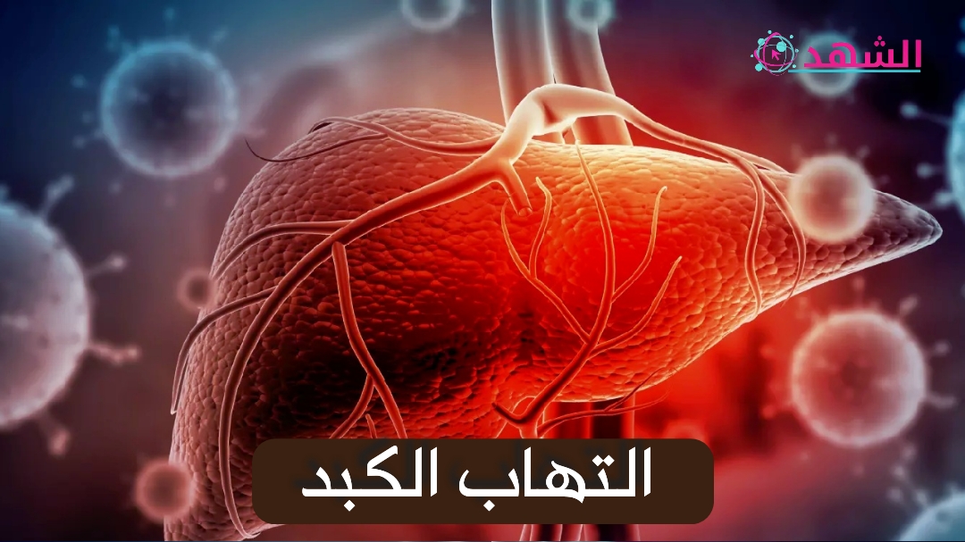 التهاب الكبد
