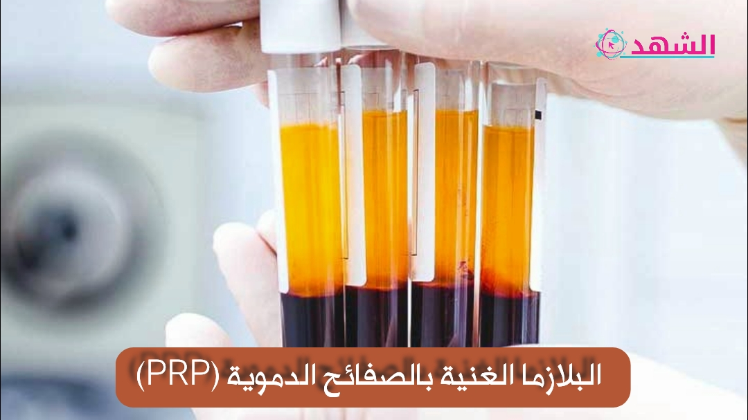 البلازما الغنية بالصفائح الدموية (PRP)