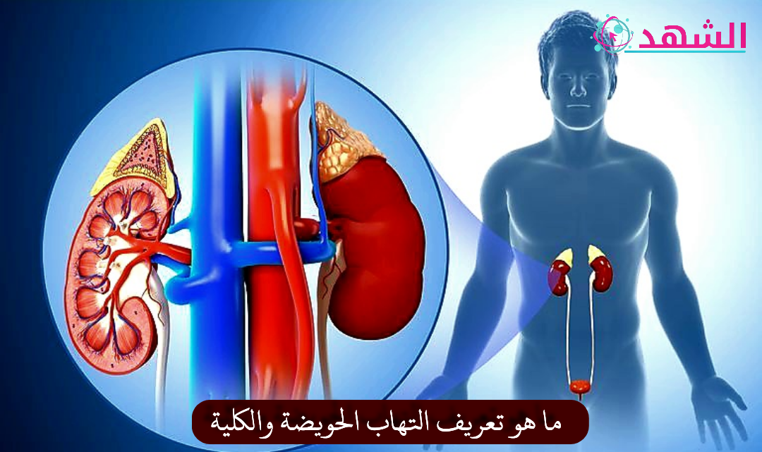 ما هو تعريف التهاب الحويضة والكلية